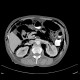 Pneumoretroperitoneum, pneumomediastinum, complication of colonoscopy: CT - Computed tomography